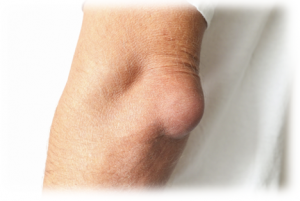 Bursitis of the elbow